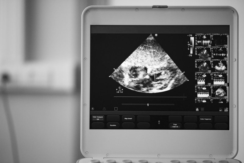 What Are the Benefits of Buying a Portable Ultrasound Machine?