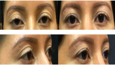 Eyelid Blepharoplasty in Minneapolis, MN, Has Helped Many to Enjoy More Youthful Appearances