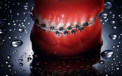 Get The Best Deals On Invisalign Treatment in Miami Lakes