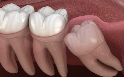 Wisdom Tooth Extraction Louisville Explained for Busy Families Looking for Relief