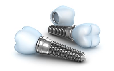 Enhance Your Quality of Life with Dental Implants in Maplewood, MN and Modern Care